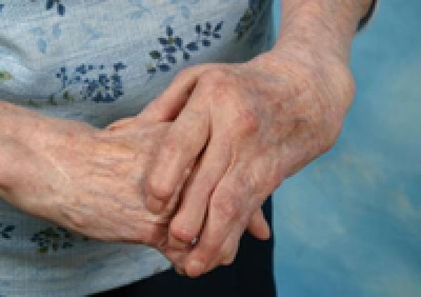  Those taking oral steroids twice as likely to have vitamin D deficiency