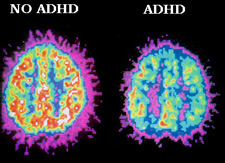 http://www.topnews.in/files/ADHD-Brain.jpg