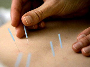 Researchers unlock secret behind acupuncture
