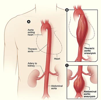 Y chromosome may have a link to fatal aortic aneurysm in men