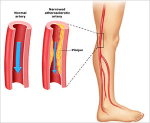 Healthy lifestyle changes can help treat peripheral arterial disease