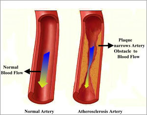 New chemical imaging technique may help combat atherosclerosis