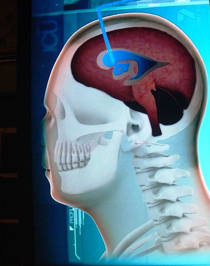 New imaging device helps scientists see tumour cells travelling in brain