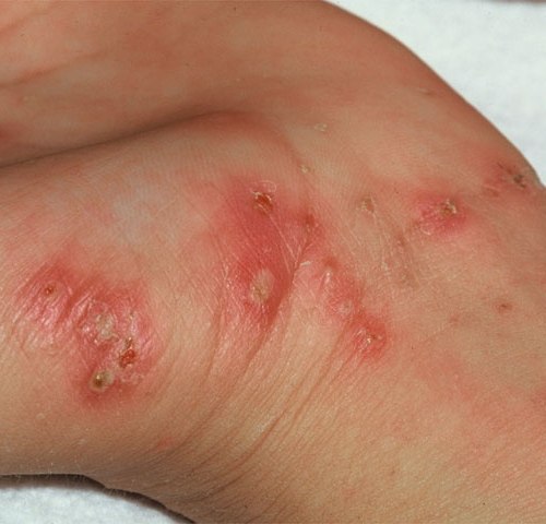 Student dies of Bacterial meningitis