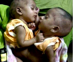 Doctors hopeful for conjoined twins separated in Australia