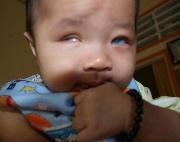 Blind-Babies