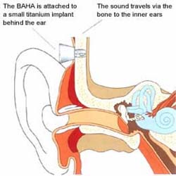 Bone-Anchored Hearing Helpful For Kids With Single-Sided Deafness