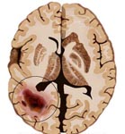 Brain Tumor