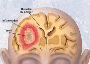 Researches Found Genetics Of Kids' Brain Tumour