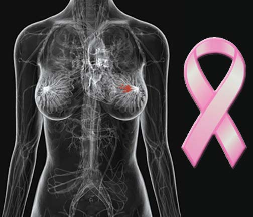 Breast cancer 