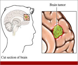 Scientists find potential way to stop cancers seed in brain