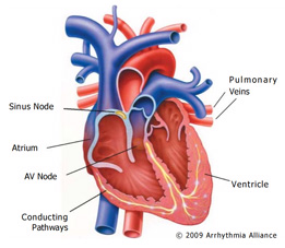 Cardiac Arrest
