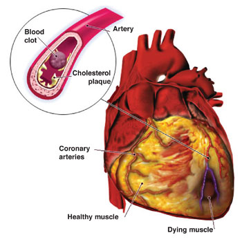 heart disease pictures. Cardiovascular disease can