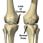 Flexible, resilient gel may replace damaged cartilage