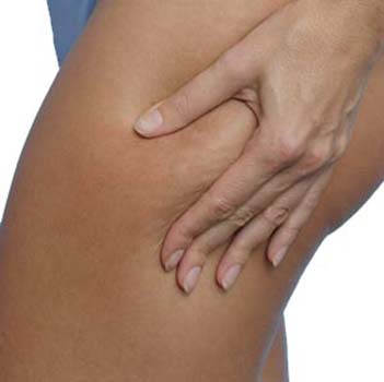 Choose exercise over creams in fight against cellulite