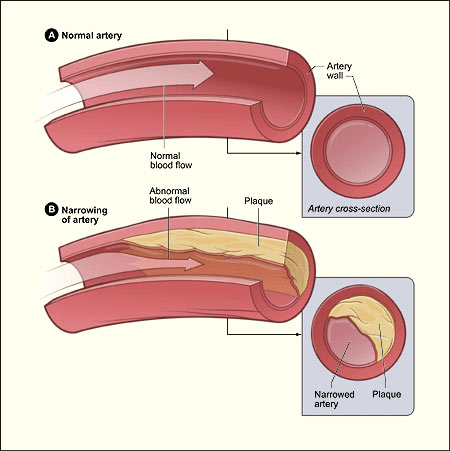 HDL et LDL