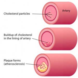 High Levels Of ‘Good’ Cholesterol May Be Dangerous For Diabetic Women