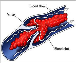 Clotting in veins close to skin linked to life-threatening deep-vein blood clots