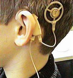 Cochlear-implants