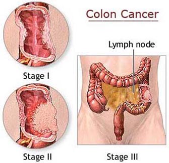 Diets rich in meat and fats and low in carbohydrates up colon cancer risk