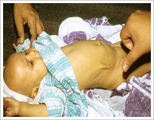Orissa's Kalahandi district hit by diarrhoea