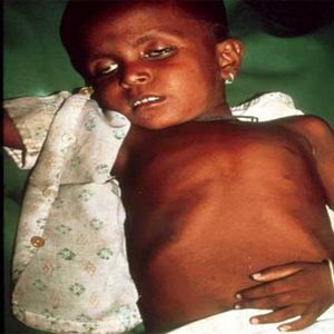 Diarrhoea outbreaks in Shimla with 53 new cases