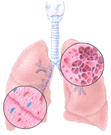 Study Links Child Smoke Exposure to Development of Emphysema