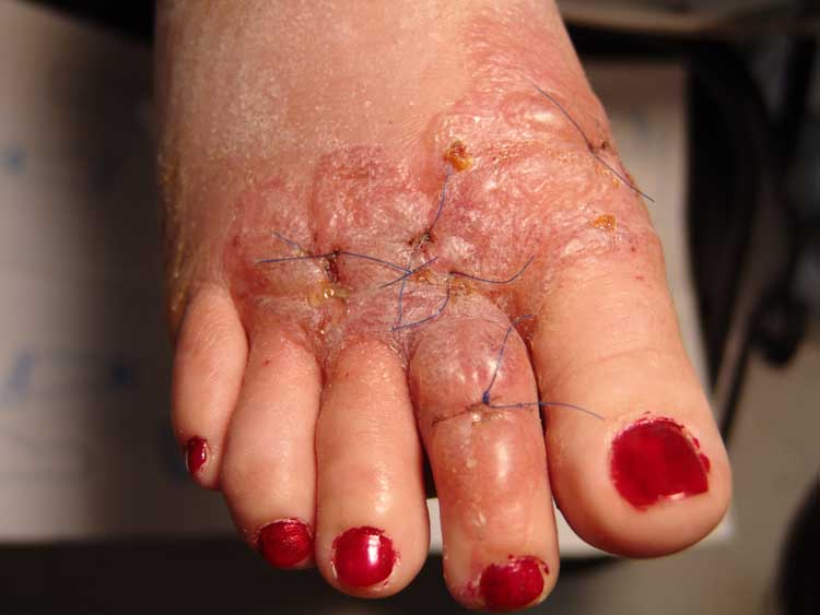 Surgeons Warn Patients To Avoid Cosmetic Foot Surgery