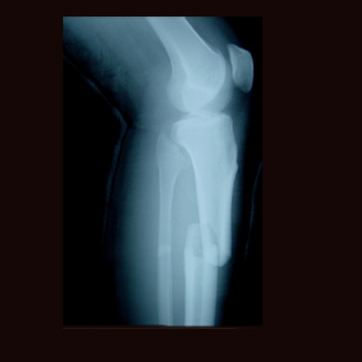 complete bone fracture complete bone fracture