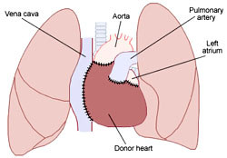 Heart transplant patients face higher risk of skin cancers