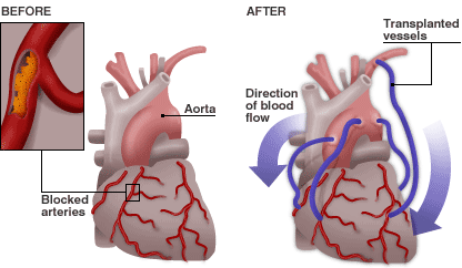 Study: Heart Bypass Better Than Angioplasty