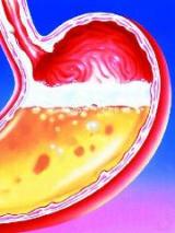 Heartburn drugs reduce anti-clotting action of clopidogrel 