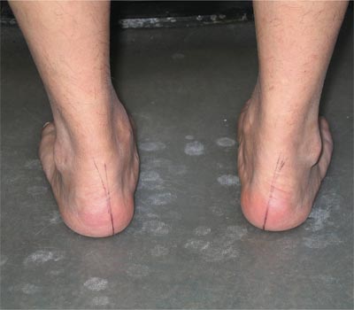 Most injuries in China are caused due to falls