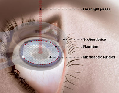 Laser eye surgery doesn’t harm cornea