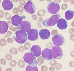 Drug that inhibits acute leukemia cell growth discovered