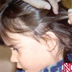 More effective method to eradicate lice found