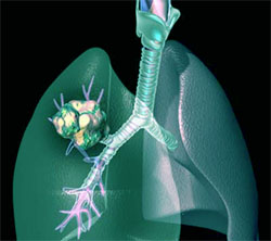 Drug ‘can shrink lung cancer tumours’