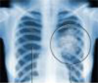 Lung cancer kills 80,000 a year, but there’s hope