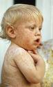 Jammu, Kashmir Hit By Measles Epidemic 