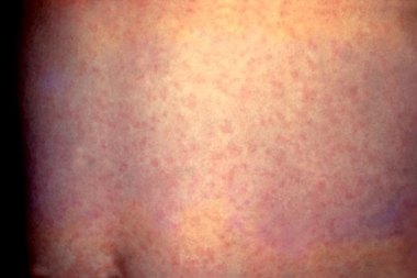Measles Outbreak in the Town of Te Awamutu