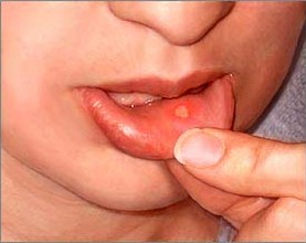 Mouth ulcer gels unsafe for kids, say experts