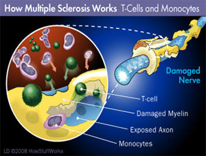 Men more likely to dump women after cancer or multiple sclerosis diagnosis