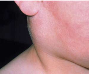 Season Brings Wave of Mumps Cases 