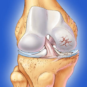 Childhood abuse may be linked to osteoarthritis