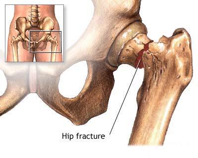 Medication for Osteoporosis makes you more prone to hip fracture