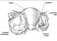 Early diagnosis of ovarian cancer leads to 90 per cent chance of survival