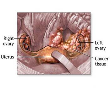 Drinking Tea Lessens Risk Of Ovarian Cancer