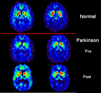 Parkinson