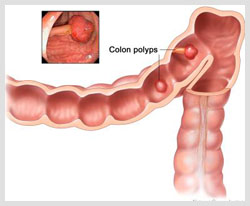 New drug target may help treat chronic rhinosinusitis with polyps