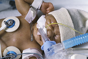 Global premature births, deaths on increase